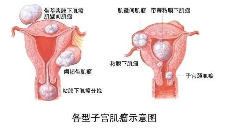 肌瘤最新进展研究及治疗策略探讨