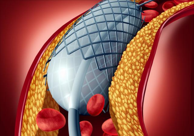 最新心血管支架价格及其影响因素分析